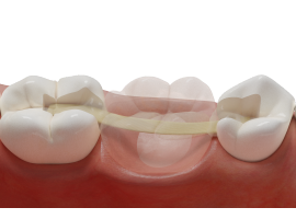 нити для шинирования и микропротезирования PFU